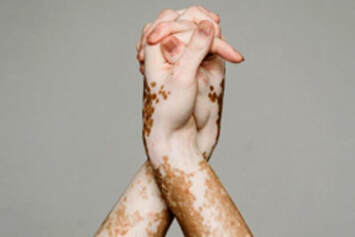 Latest Homeopathic Medicine For Vitiligo