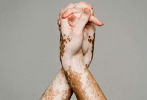 Top Vitiligo Treatment in Chennai